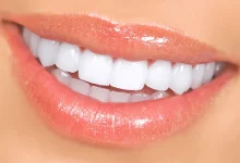 a-fresh,-confident-smile-with-dental-veneers-in-sydney