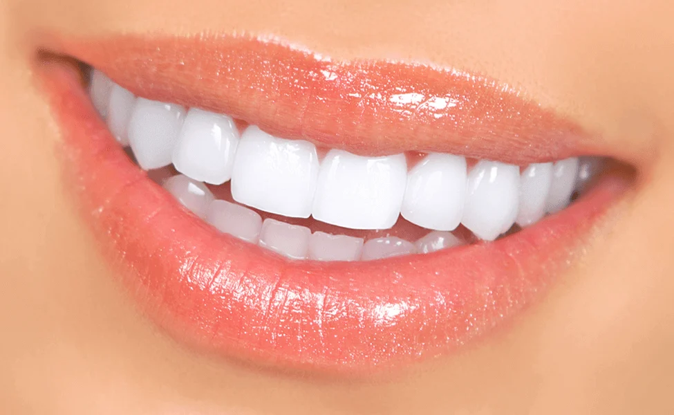 a-fresh,-confident-smile-with-dental-veneers-in-sydney